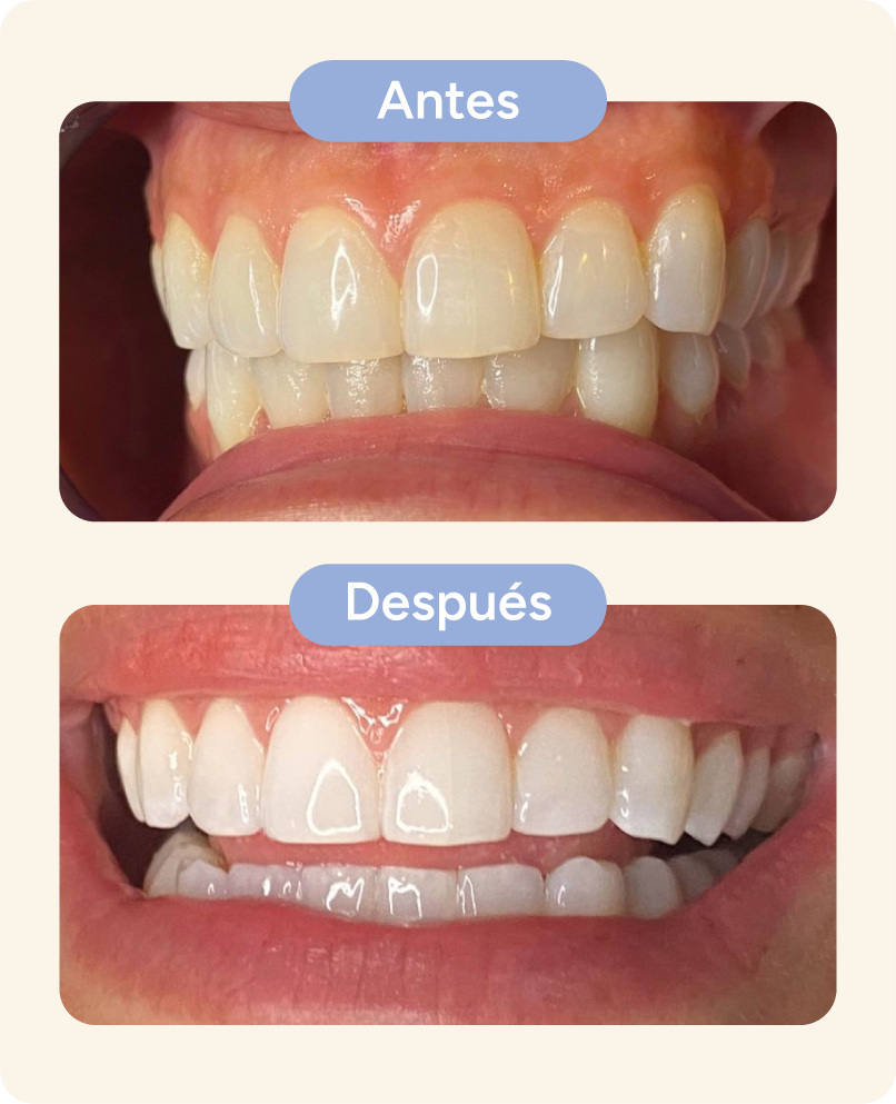 foto2 blanqueamiento