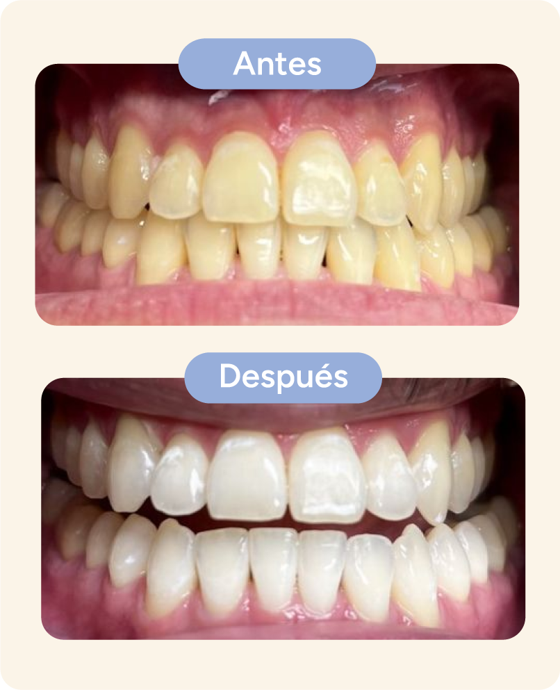 foto3 blanqueamiento