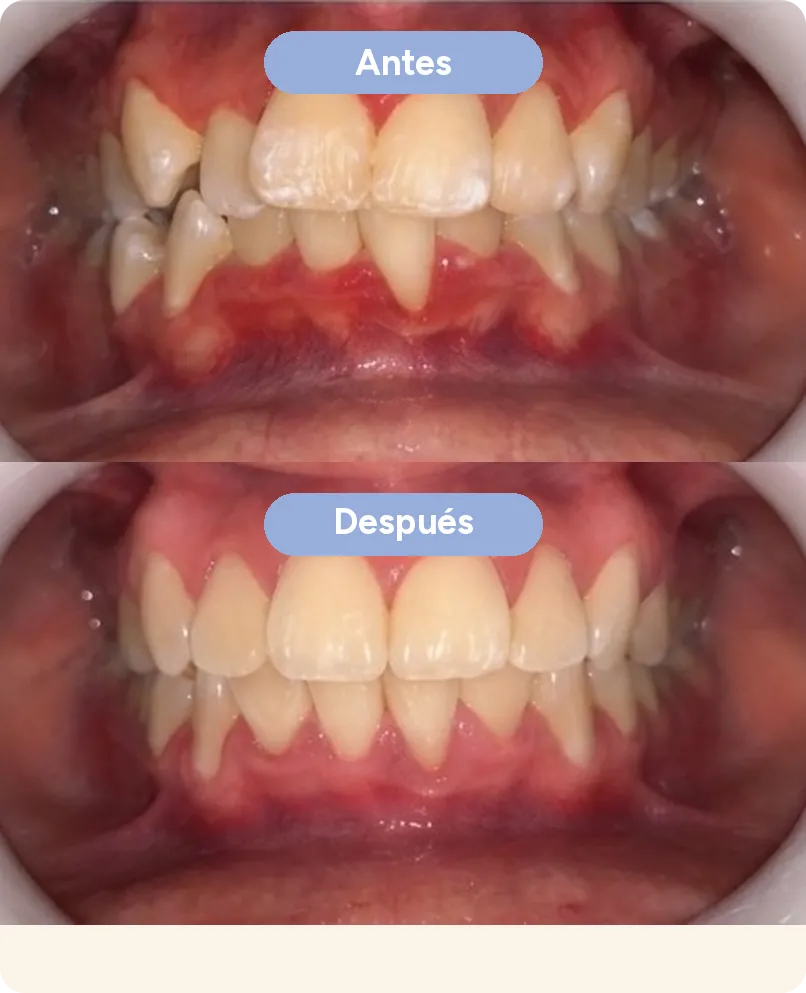 Antes y después con alineadores invisibles en Sonrisse: dientes de arriba y de abajo apiñados que quedan alineados