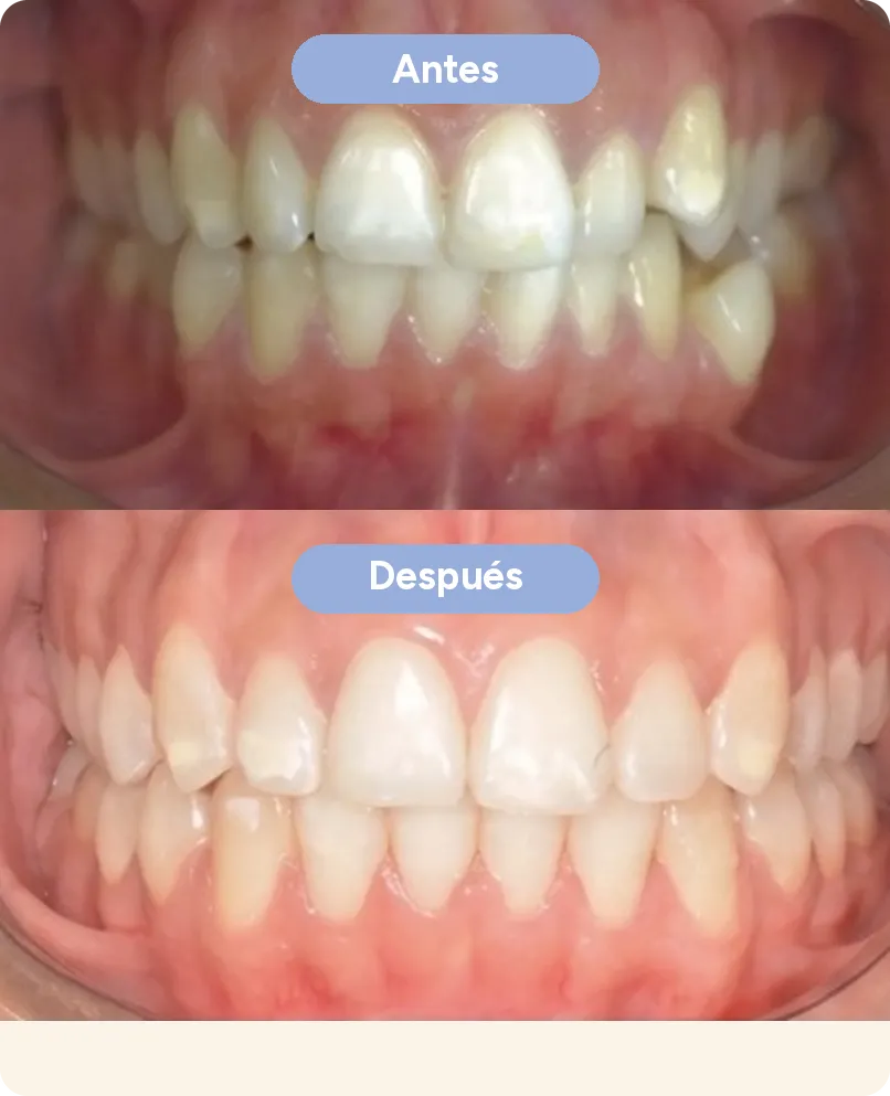 Antes y después con alineadores invisibles en Sonrisse: dientes apiñados y montados que quedan alineados