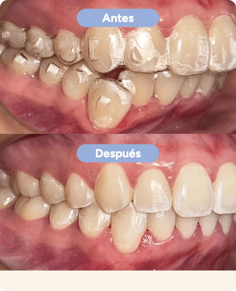Antes y después con alineadores invisibles en Sonrisse: un diente que estaba fuera de la línea vuelve a su lugar en la arcada