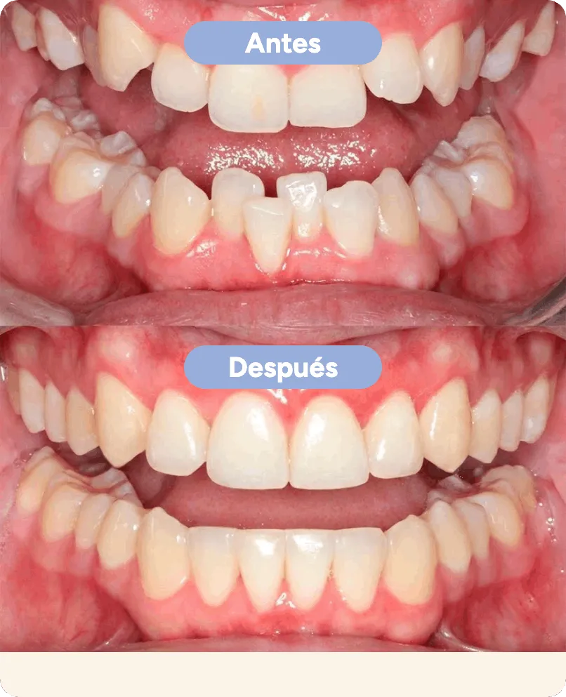 Antes y después con alineadores invisibles en Sonrisse: dientes de abajo apiñados y girados que quedan alineados