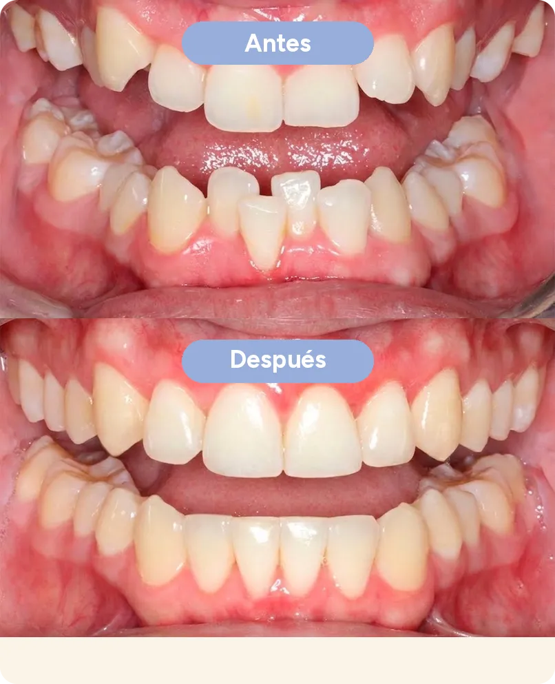 Antes y después con alineadores invisibles en Sonrisse: dientes de abajo apiñados que quedan parejos