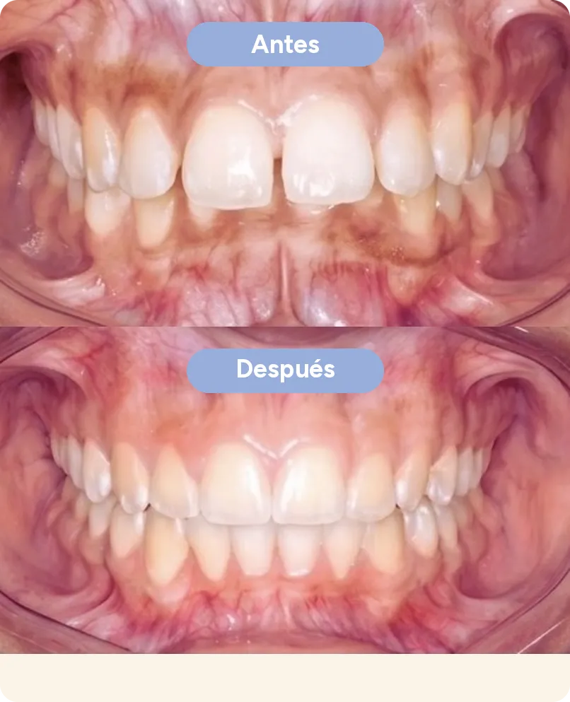 Antes y después con alineadores invisibles en Sonrisse: dientes de adelante separados que se cierran moviéndolos, sin carillas